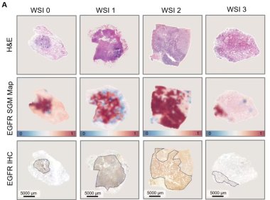 AI病理大模型实现肺癌基因突变快速预测，准确率达78%-99%